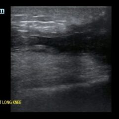 A Case Report of Rare Bilateral Quadriceps Tendon Rupture Diagnosed by Point of Care Ultrasound (POCUS) 9 Bilateral Quadriceps Tendon Rupture. Right Long Knee US. JETem 2026
