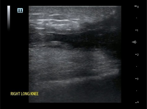 A Case Report of Rare Bilateral Quadriceps Tendon Rupture Diagnosed by Point of Care Ultrasound (POCUS) 8 Bilateral Quadriceps Tendon Rupture. Right Long Knee US. JETem 2026