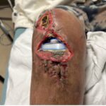 Prosthetic Joint Infection Open Knee Photo AP Annotated. JETem 2026