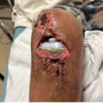 Prosthetic Joint Infection Open Knee Photo AP. JETem 2026