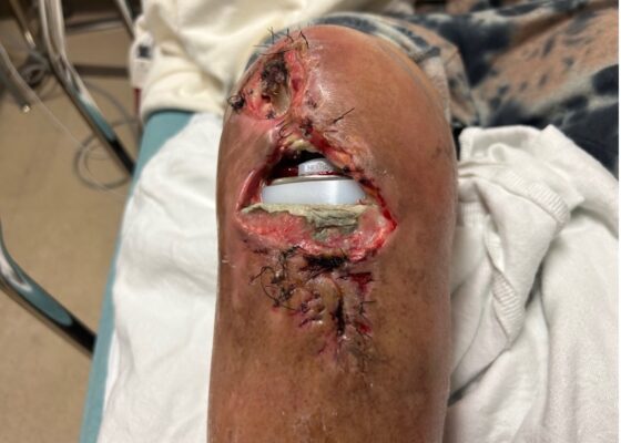 Visual Case Report of a Prosthetic Joint Infection and Chronic Dehiscence following a Total Knee Arthroplasty 2 Prosthetic Joint Infection Open Knee Photo AP. JETem 2026