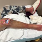 Prosthetic Joint Infection Open Knee Photo All Annotated. JETem 2026