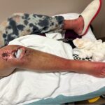 Prosthetic Joint Infection Open Knee Photo All. JETem 2026