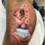 Prosthetic Joint Infection Open Knee Photp AP 2 Annotated. JETem 2026