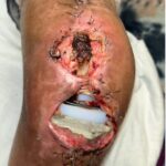 Prosthetic Joint Infection Open Knee Photp AP 2. JETem 2026