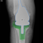 Prosthetic Joint Infection Open Knee XR AP Annotated. JETem 2026