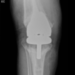 Prosthetic Joint Infection Open Knee XR AP. JETem 2026