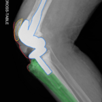 Prosthetic Joint Infection Open Knee XR Cross Table Annotated. JETem 2026