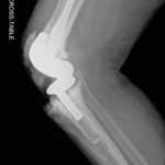 Prosthetic Joint Infection Open Knee XR Cross Table. JETem 2026