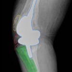 Prosthetic Joint Infection Open Knee XR Lateral Annotated. JETem 2026