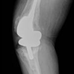 Prosthetic Joint Infection Open Knee XR Lateral. JETem 2026