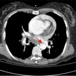 Rapidly Progressive Painless Acute Aortic Dissection: A Case Report 12 Rapidly Progressive Painless Acute Aortic Dissection. CT Axial Aortic Arch Annotated. JETem 2026