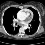 Rapidly Progressive Painless Acute Aortic Dissection: A Case Report 1 Rapidly Progressive Painless Acute Aortic Dissection. CT Axial Aortic Arch. JETem 2026