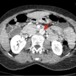 Rapidly Progressive Painless Acute Aortic Dissection: A Case Report 13 Rapidly Progressive Painless Acute Aortic Dissection. CT Axial Level of the Kidneys Annotated. JETem 2026