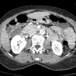 Rapidly Progressive Painless Acute Aortic Dissection: A Case Report 2 Rapidly Progressive Painless Acute Aortic Dissection. CT Axial Level of the Kidneys. JETem 2026