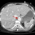 Rapidly Progressive Painless Acute Aortic Dissection: A Case Report 14 Rapidly Progressive Painless Acute Aortic Dissection. CT Axial Level of the Liver Annotated. JETem 2026