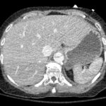 Rapidly Progressive Painless Acute Aortic Dissection: A Case Report 3 Rapidly Progressive Painless Acute Aortic Dissection. CT Axial Level of the Liver. JETem 2026