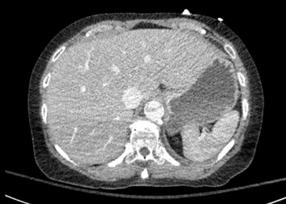 Rapidly Progressive Painless Acute Aortic Dissection: A Case Report 4 Rapidly Progressive Painless Acute Aortic Dissection. CT Axial Level of the Liver. JETem 2026