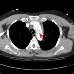Rapidly Progressive Painless Acute Aortic Dissection: A Case Report 15 Rapidly Progressive Painless Acute Aortic Dissection. CT Axial Thoracic Annotated. JETem 2026