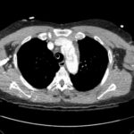 Rapidly Progressive Painless Acute Aortic Dissection: A Case Report 4 Rapidly Progressive Painless Acute Aortic Dissection. CT Axial Thoracic. JETem 2026