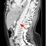 Rapidly Progressive Painless Acute Aortic Dissection: A Case Report 16 Rapidly Progressive Painless Acute Aortic Dissection. CT Sagittal Annotated. JETem 2026