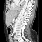 Rapidly Progressive Painless Acute Aortic Dissection: A Case Report 5 Rapidly Progressive Painless Acute Aortic Dissection. CT Sagittal. JETem 2026