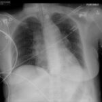 Rapidly Progressive Painless Acute Aortic Dissection: A Case Report 6 Rapidly Progressive Painless Acute Aortic Dissection. CXR. JETem 2026