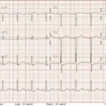 Rapidly Progressive Painless Acute Aortic Dissection: A Case Report 7 Rapidly Progressive Painless Acute Aortic Dissection. ECG. JETem 2026