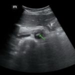 Rapidly Progressive Painless Acute Aortic Dissection: A Case Report 17 Rapidly Progressive Painless Acute Aortic Dissection. US Dissection 1 Annotated. JETem 2026