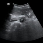 Rapidly Progressive Painless Acute Aortic Dissection: A Case Report 8 Rapidly Progressive Painless Acute Aortic Dissection. US Dissection 1. JETem 2026