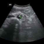 Rapidly Progressive Painless Acute Aortic Dissection: A Case Report 18 Rapidly Progressive Painless Acute Aortic Dissection. US Dissection 2 Annotated. JETem 2026