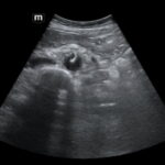 Rapidly Progressive Painless Acute Aortic Dissection: A Case Report 9 Rapidly Progressive Painless Acute Aortic Dissection. US Dissection 2. JETem 2026