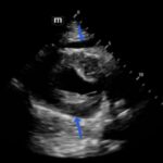 Rapidly Progressive Painless Acute Aortic Dissection: A Case Report 19 Rapidly Progressive Painless Acute Aortic Dissection. US Pericardial Effusion Annotated. JETem 2026