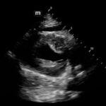 Rapidly Progressive Painless Acute Aortic Dissection: A Case Report 10 Rapidly Progressive Painless Acute Aortic Dissection. US Pericardial Effusion. JETem 2026