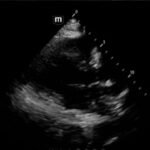 Rapidly Progressive Painless Acute Aortic Dissection: A Case Report 11 Rapidly Progressive Painless Acute Aortic Dissection. US Prior to Effusion. JETem 2026