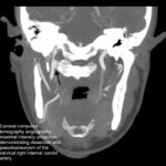Blunt Cerebrovascular Injury. CT Coronal Internal Carotid Annotated. JETem 2026