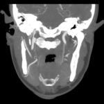 Blunt Cerebrovascular Injury. CT Coronal Internal Carotid Unannotated. JETem 2026