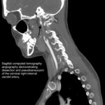 Blunt Cerebrovascular Injury. CT Sagital Internal Carotid Annotated. JETem 2026