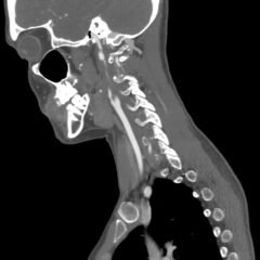 Blunt Cerebrovascular Injury: A Visual Case Report with Computed Tomography Angiography Findings Revealing Carotid and Vertebral Artery Dissection 12 Blunt Cerebrovascular Injury. CT Sagital Internal Carotid Unannotated. JETem 2026