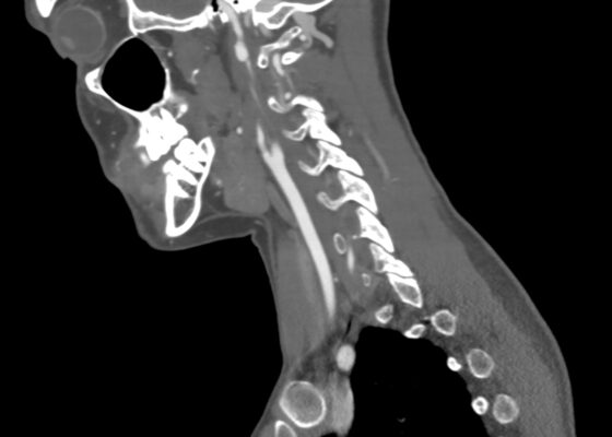 Blunt Cerebrovascular Injury: A Visual Case Report with Computed Tomography Angiography Findings Revealing Carotid and Vertebral Artery Dissection 2 Blunt Cerebrovascular Injury. CT Sagital Internal Carotid Unannotated. JETem 2026