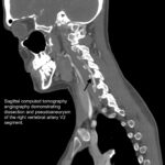Blunt Cerebrovascular Injury. CT Sagital Vertebral Artery Annotated. JETem 2026