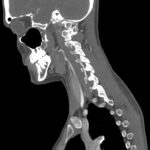 Blunt Cerebrovascular Injury. CT Sagital Vertebral Artery Unannotated. JETem 2026