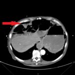 Caught in the Whirl: A Case Report of Midgut Volvulus in an Elderly Patient 5 Caught in the Whirl. CTA Axial Annotated. JETem 2026
