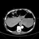 Caught in the Whirl: A Case Report of Midgut Volvulus in an Elderly Patient 1 Caught in the Whirl. CTA Axial Unannotated. JETem 2026