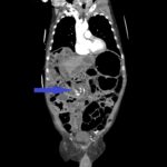 Caught in the Whirl: A Case Report of Midgut Volvulus in an Elderly Patient 6 Caught in the Whirl. CTA Coronal 1 Annotated. JETem 2026