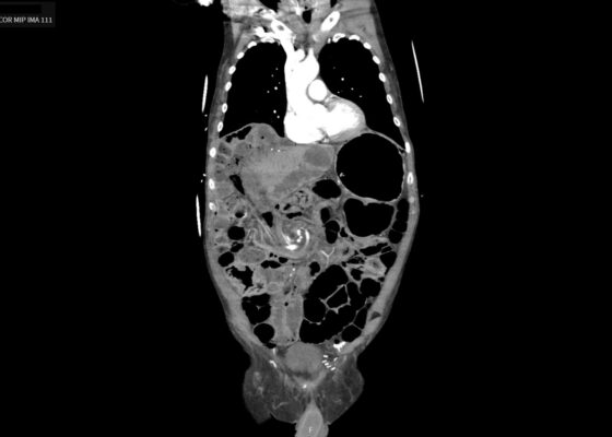 Caught in the Whirl: A Case Report of Midgut Volvulus in an Elderly Patient 4 Caught in the Whirl. CTA Coronal 1 Unannotated. JETem 2026