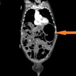 Caught in the Whirl: A Case Report of Midgut Volvulus in an Elderly Patient 7 Caught in the Whirl. CTA Coronal 2 Annotated. JETem 2026