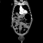 Caught in the Whirl: A Case Report of Midgut Volvulus in an Elderly Patient 3 Caught in the Whirl. CTA Coronal 2 Unannotated. JETem 2026