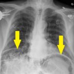 Caught in the Whirl: A Case Report of Midgut Volvulus in an Elderly Patient 8 Caught in the Whirl. CXR Annotated. JETem 2026