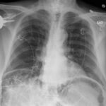 Caught in the Whirl: A Case Report of Midgut Volvulus in an Elderly Patient 4 Caught in the Whirl. CXR Unannotated. JETem 2026